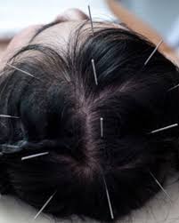 CERTIFICATE IN SCALP ACUPUNCTURE